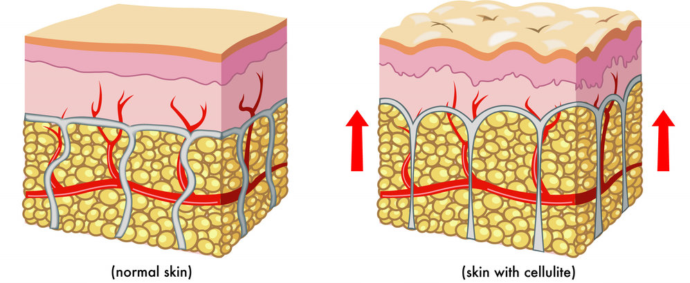 How To Get Rid Of Cellulite To Be Summer Ready
