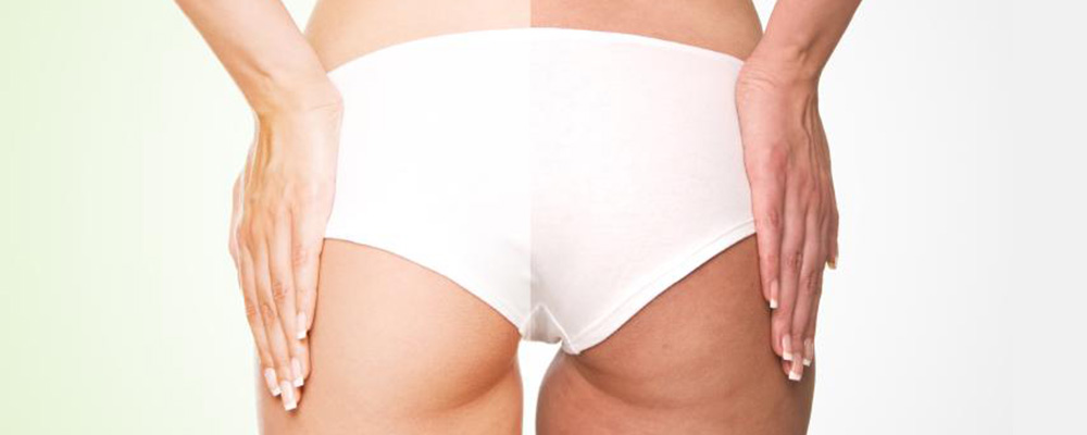 How To Get Rid Of Cellulite To Be Summer Ready