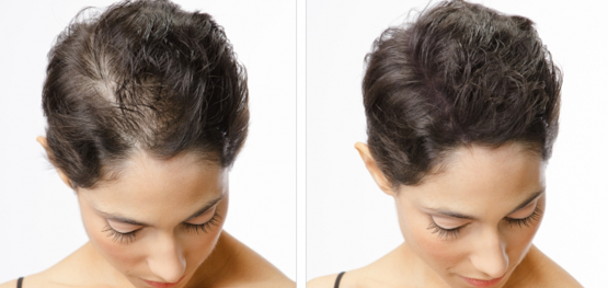 Hair tips -Surgical Treatments Hair tips -Surgical Treatments