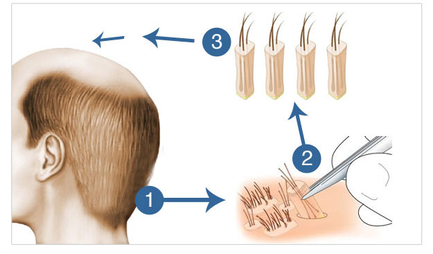 Hair tips -Surgical Treatments Hair tips -Surgical Treatments